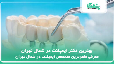بهترین دکتر ایمپلنت در شمال تهران