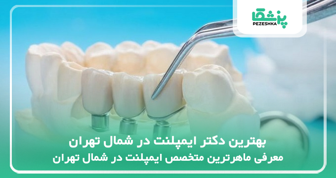 بهترین دکتر ایمپلنت در شمال تهران