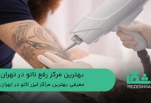 بهترین مرکز رفع تاتو در تهران