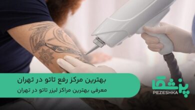 بهترین مرکز رفع تاتو در تهران