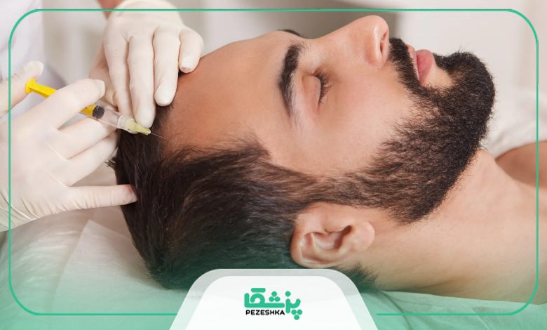 کاربردهای روش مزوتراپی مو