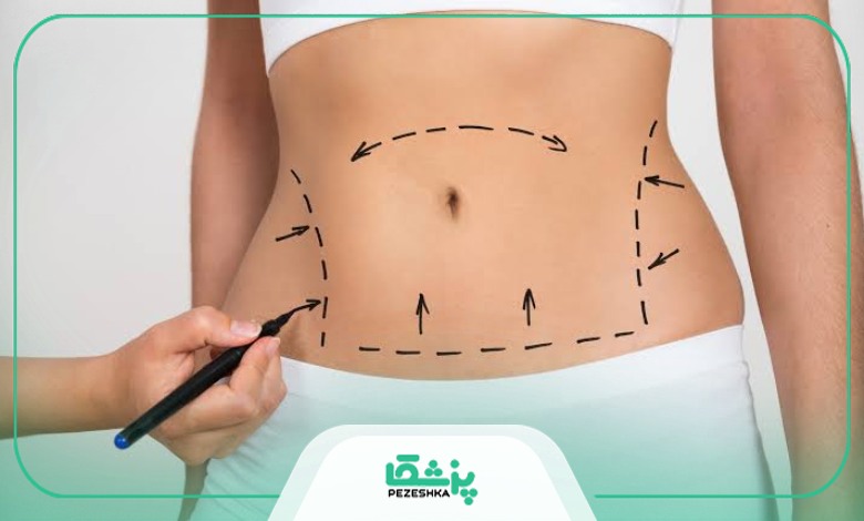مزایا ابدومینوپلاستی