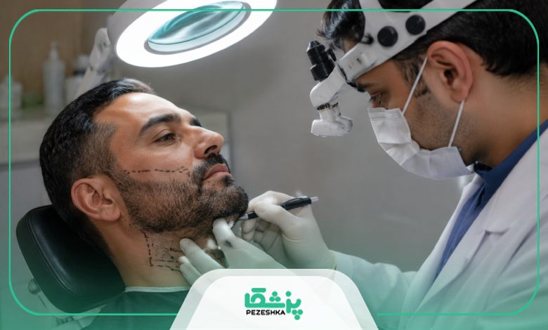 مراحل کاشت ریش