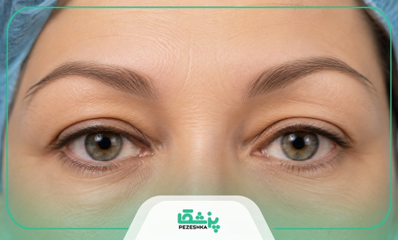 جراحی بلفاروپلاستی چیست؟