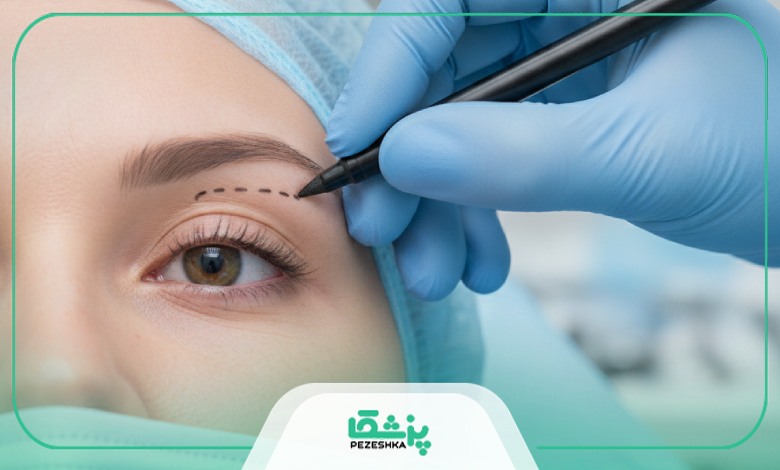 جراحی بلفاروپلاستی چیست؟