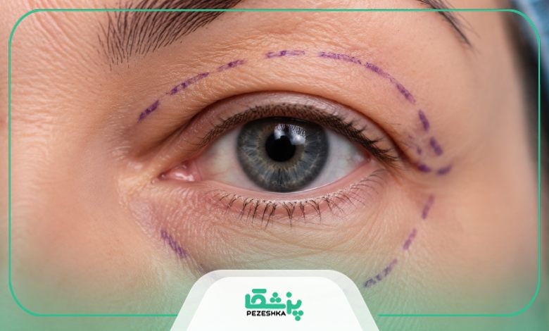عوارض جراحی بلفاروپلاستی