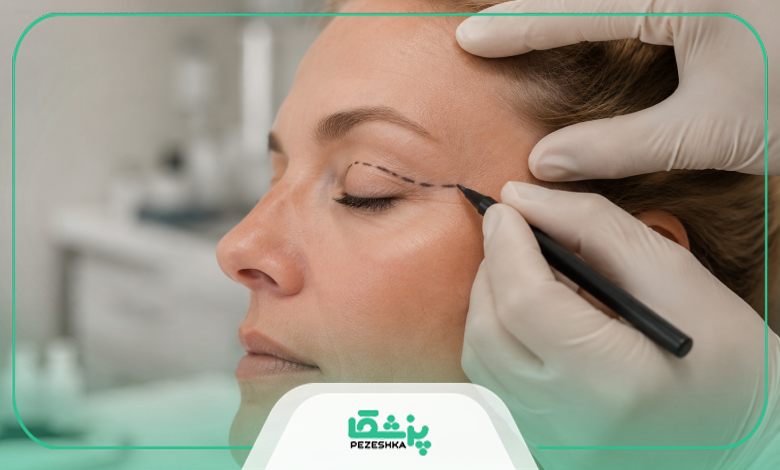 روش های شناخت بهترین جراح بلفاروپلاستی در سعادت آباد