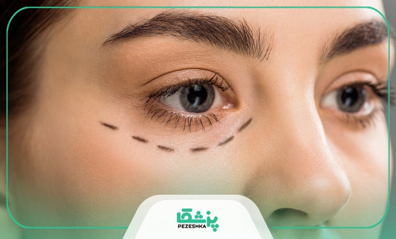 جراحی بلفاروپلاستی چیست؟