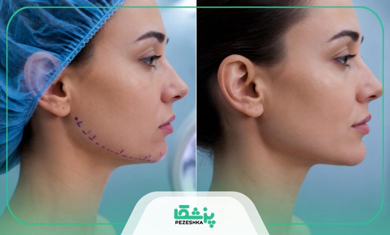 توصیه های مهم بهترین جراح چانه در تهران پس از جراحی چانه