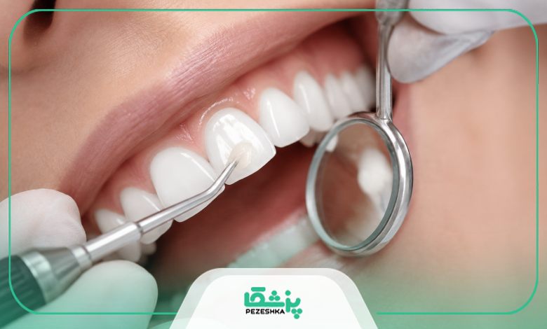 کامپوزیت دندان چیست؟