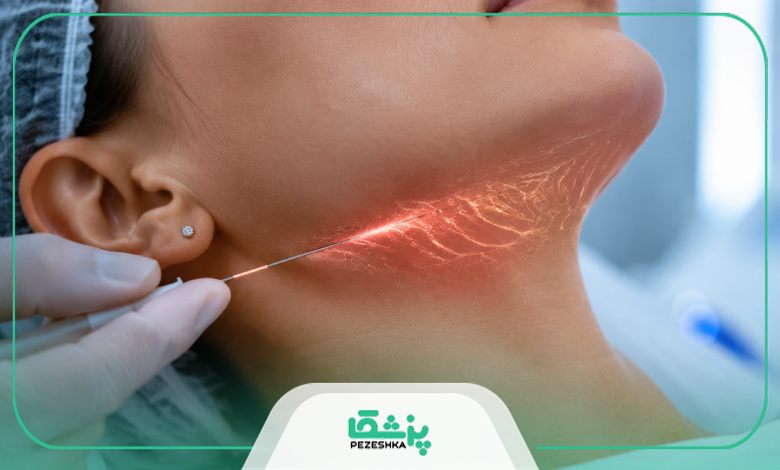 نکات مراقبتی پس از اندولیفت