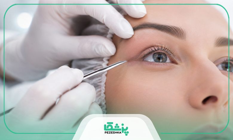جراحی زیبایی پلک چیست؟