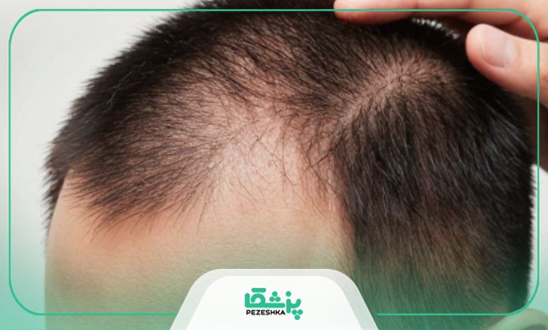 دلایل اصلی ریزش مو