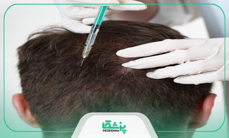 ویژگی بهترین دکتر مزوتراپی مو در ونک