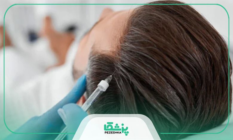تاثیر مزوتراپی بر ریزش مو