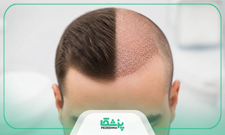 نکات مهم قبل از انجام کاشت مو