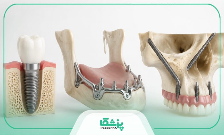 ایمپلنت دندان چند نوع دارد؟