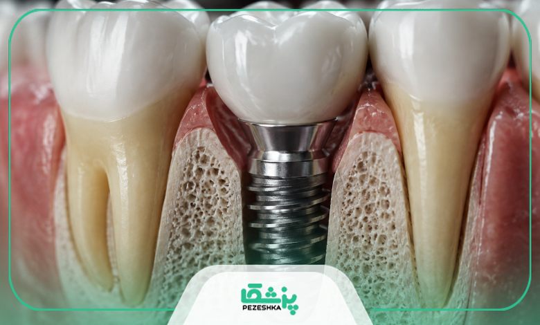 مراقبت های بعد از انجام ایمپلنت