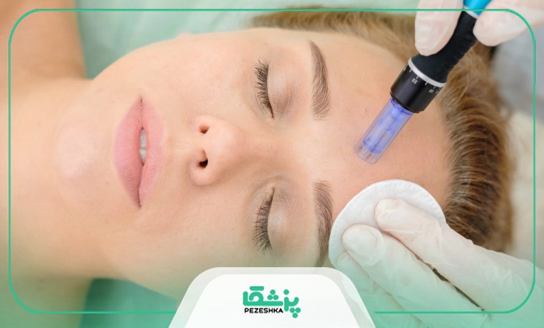 چند مدت یک بار باید میکرونیدلینگ انجام داد؟