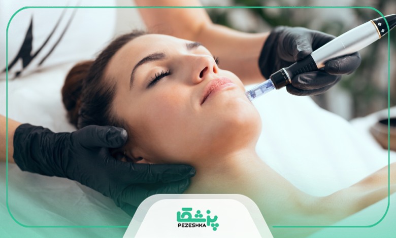 مزایای میکرونیدلینگ