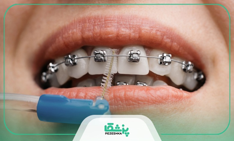 چه کسانی باید ارتودنسی انجام بدهند؟