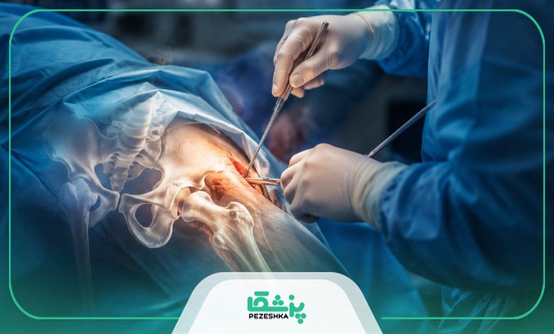 عوامل تاثیرگذار در هزینه های جراحی لگن