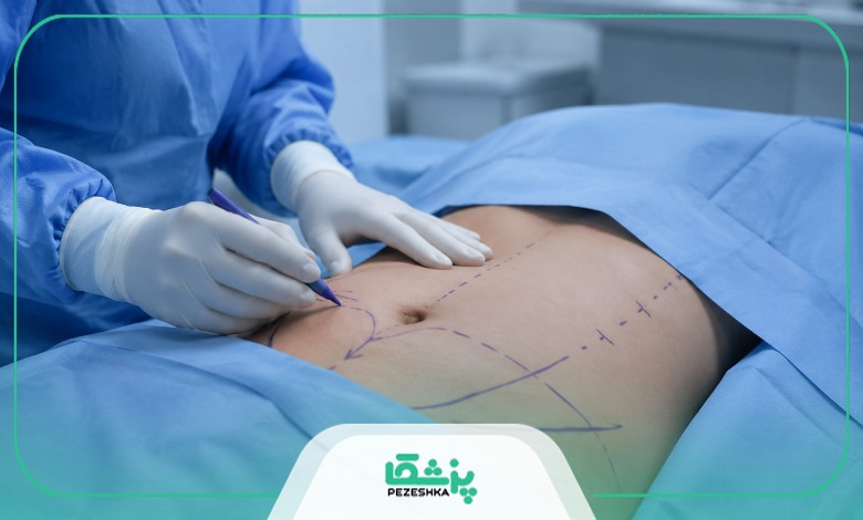 اقدامات قبل از عمل پیکر تراشی