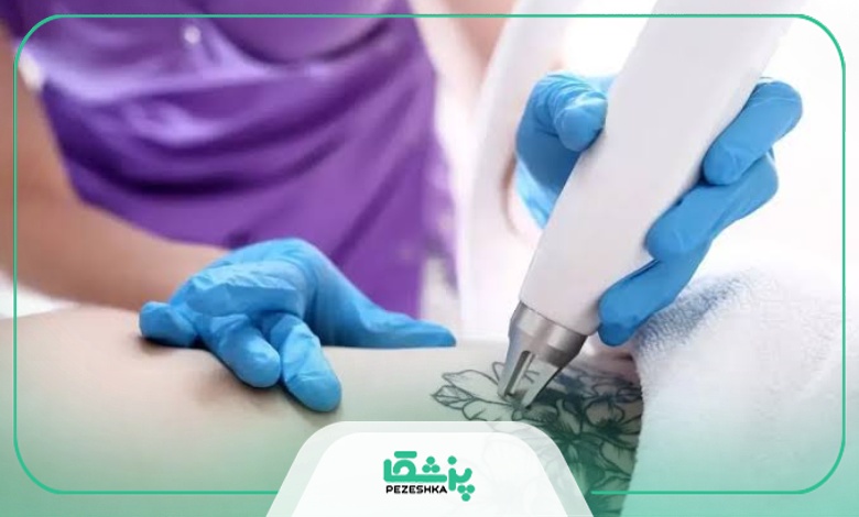 مراقبت بعد از رفع تاتو با لیزر