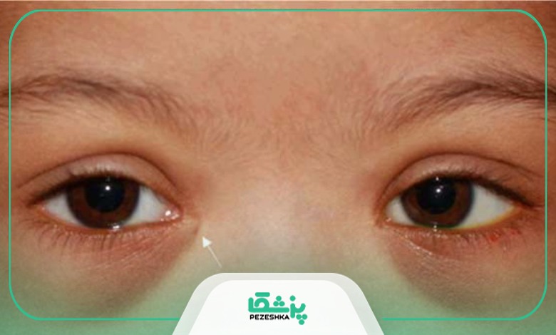 عوارض جانبی جراحی مجرای اشکی