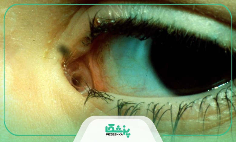 بهترین جراح مجرای اشکی در تهران چگونه بیماری انسداد مجرای اشک را در بیمار تشخیص می دهد؟