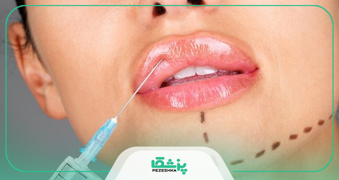 اقدامات مراقبتی قبل از تزریق ژل لب