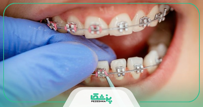 مراقبت های ارتودنسی