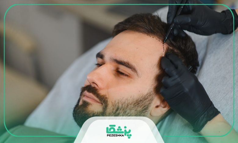 مراقبتهای مهم بعد از کاشت مو