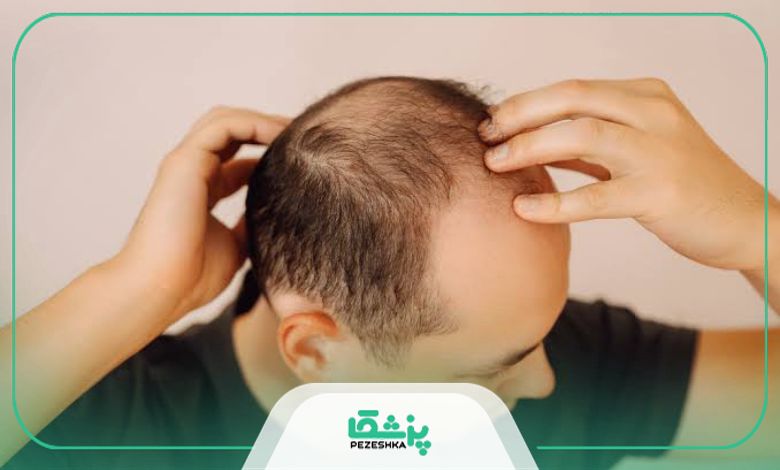 علت ریزش مو