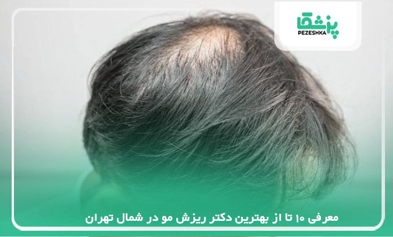 معرفی 10 تا از بهترین دکتر ریزش مو در شمال تهران【سال1405】❤️