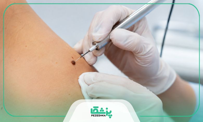 مراقبت های بعد از برداشتن خال