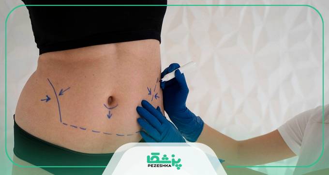هزینه جراحی پیکرتراشی + عوامل مؤثر بر قیمت