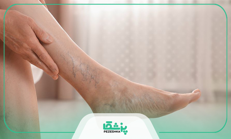 برای درمان واریس به چه متخصصی مراجعه کنیم؟