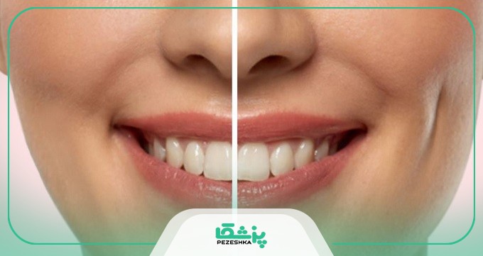 توصیه‌های بهترین دکتر ایجاد چال گونه پس از جراحی