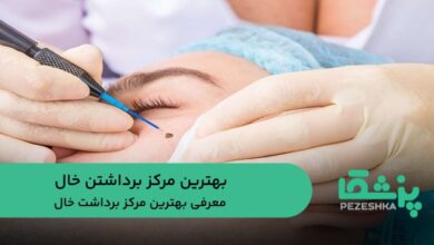 بهترین مرکز برداشتن خال