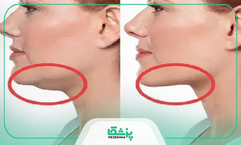 ماندگاری روشهای رفع غبغب چقدر است؟