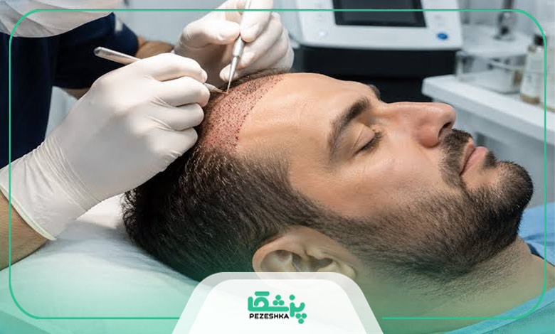 هزینه کاشت مو در تبریز در سال 1405
