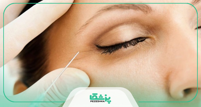 هزینه بوتاکس چقدر است؟