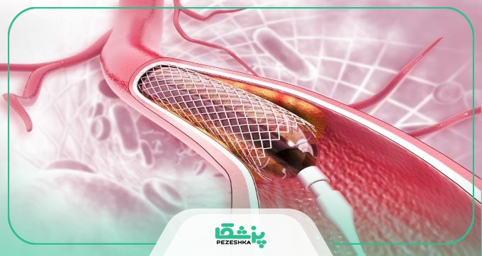 راهنمای هزینه آنژیوپلاستی توسط دکتر آنژیوپلاستی تهران