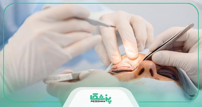 عوارض و مزایای بلفاروپلاستی؛ آیا این جراحی برای شما مناسب است؟