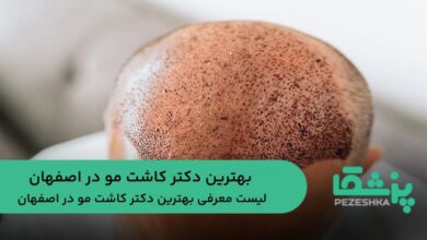 بهترین دکتر کاشت مو در اصفهان