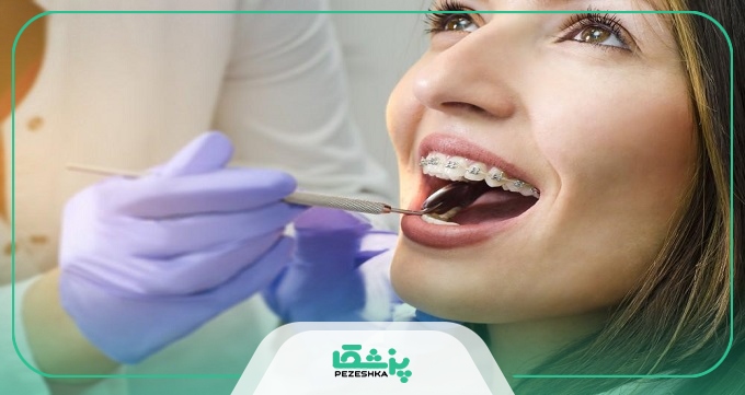 هزینه ارتودنسی در اصفهان چقدر است؟