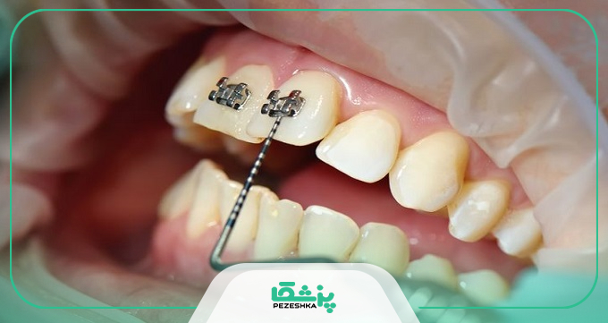 چه سنی برای انجام ارتودنسی مناسب است ؟