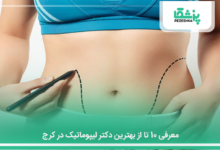 بهترین دکتر لیپوماتیک در کرج