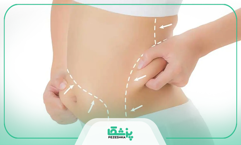 بهترین کاندیدای جراحی لیپوماتیک